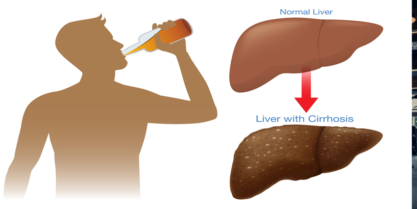 Issues in liver when you drink alcohol  